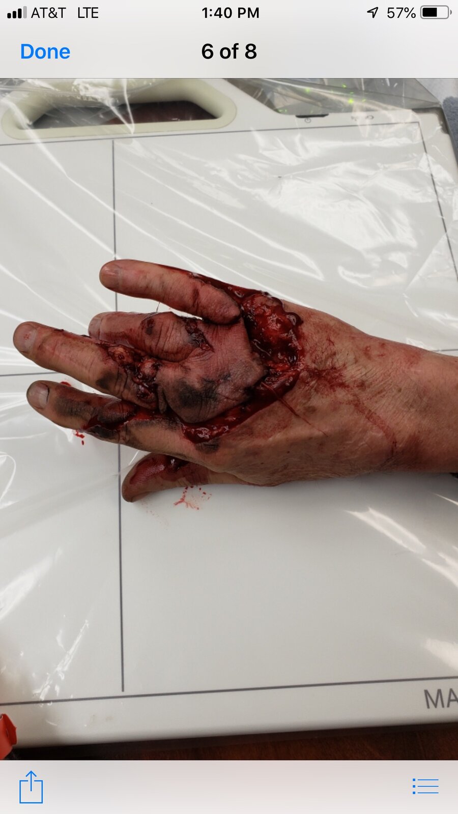 Lathe injury.jpeg